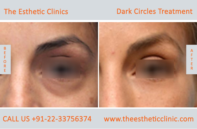 Under Eye Dark Circle Removal Laser Treatment before after photos in mumbai india (6)